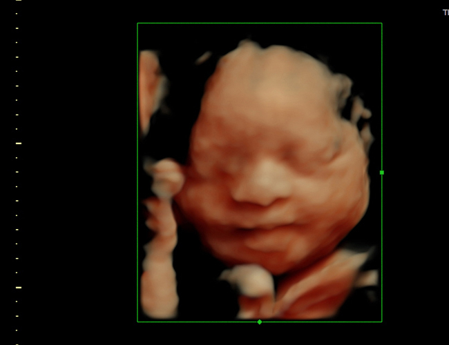 3D ultrasound image at 29 weeks